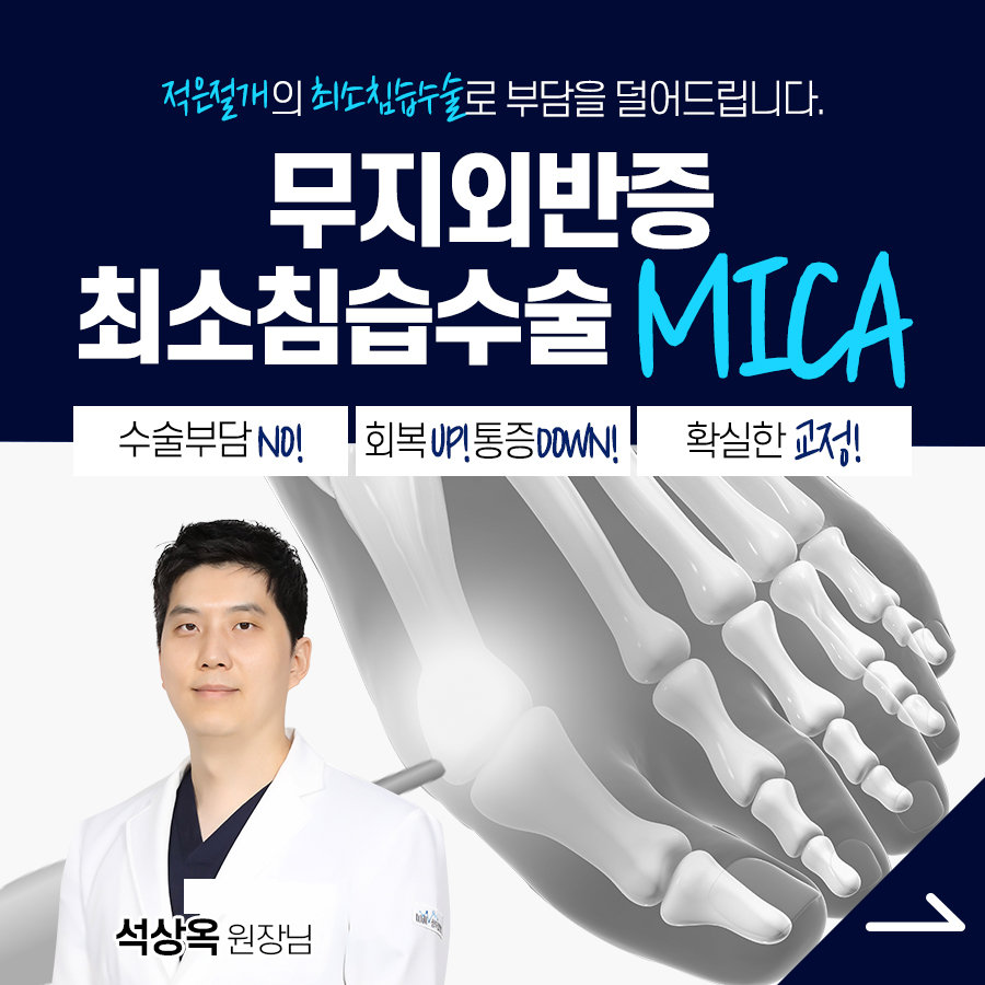 최소 침습 무지외반증 수술 이미지