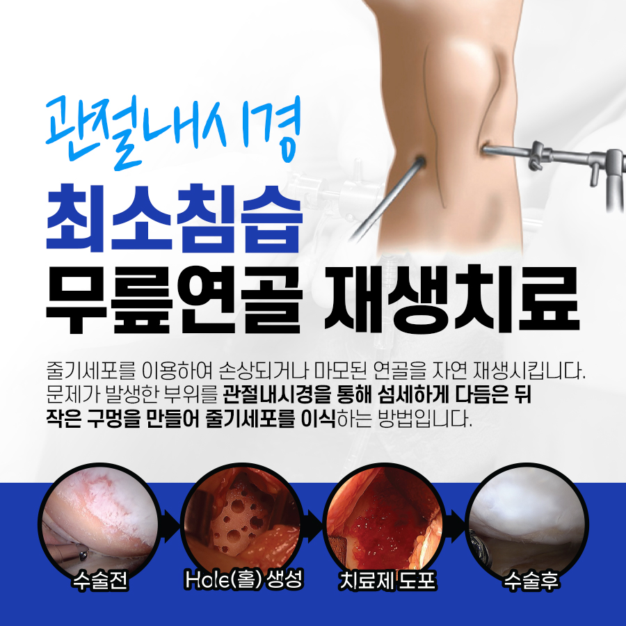 관절내시경 치료 이미지